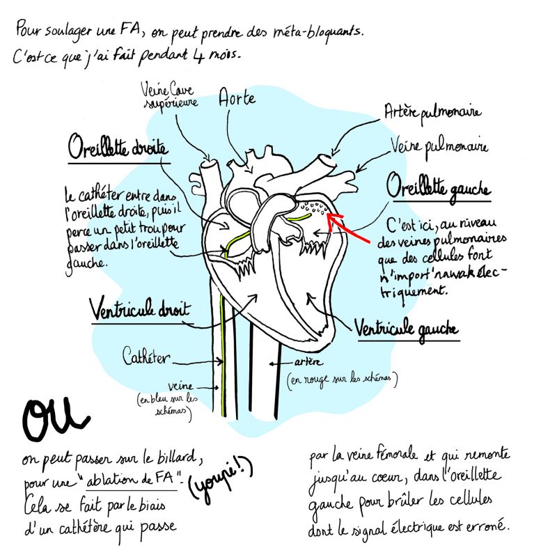 fibrillation auriculaire, ablation fa, illustration julie blaquié, clinique saint augustin